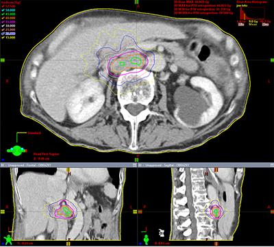 Stereotactic Body Radiotherapy for Lymph Node Oligometastases: Real-World Evidence From 90 Consecutive Patients